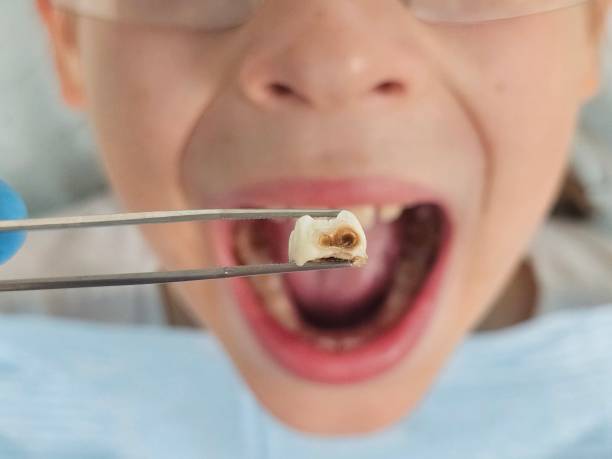 Best Emergency Wisdom Teeth Removal in Oreana, IL